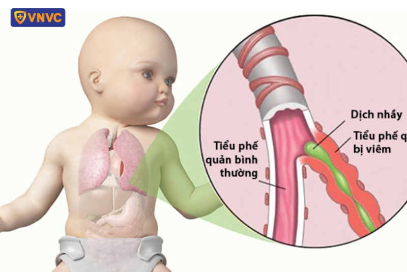TRẺ SƠ SINH MẮC VIÊM TIỂU PHẾ QUẢN NẰM THEO DÕI TẠI BỆNH VIỆN